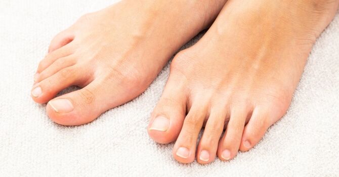 Bunion Treatment Options That Actually Relieve Pain and Improve Foot Health